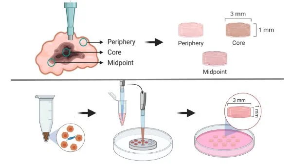a 3D engineered prostate cancer tissue model with properties that are informed by direct comparison tests with xenograft tumor tissue specimens.