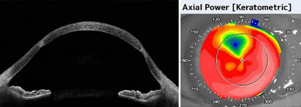 Exemplary image of corneal stiffening and keratoconic progression of the peripheral recipient bed with resulting transplant tilt