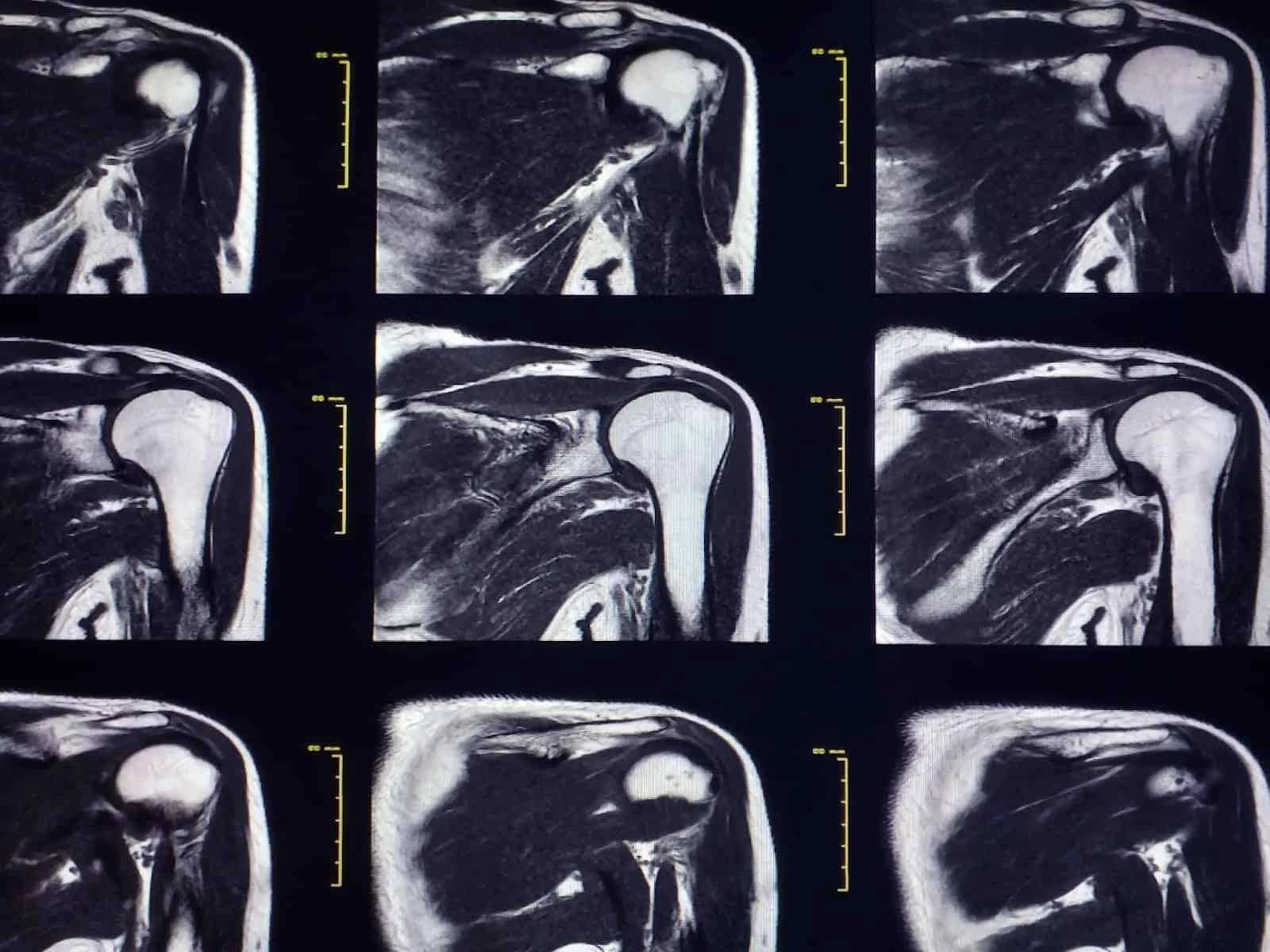 A rotator cuff biomechanics scan of a cuff tear