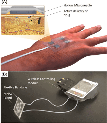 Wearable Devices for Chronic Wounds: Revolutionizing Wound Treatment