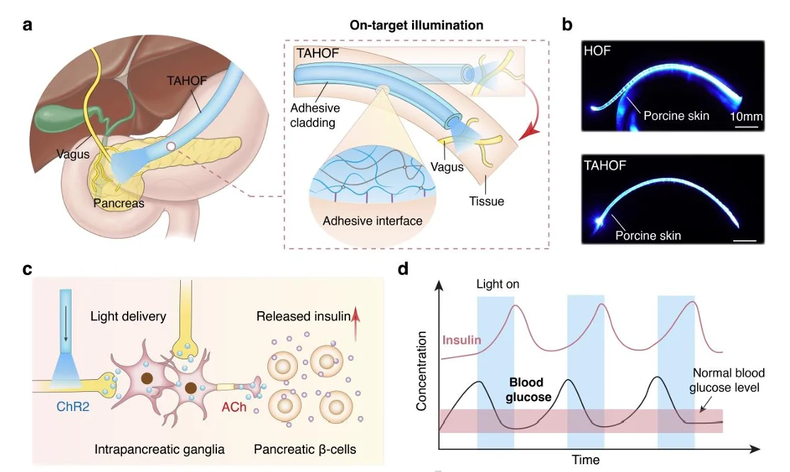 Tissue-adhesive hydrogel optical fibre positioned on the pancreas for vagus nerve stimulation and blood glucose regulation.
